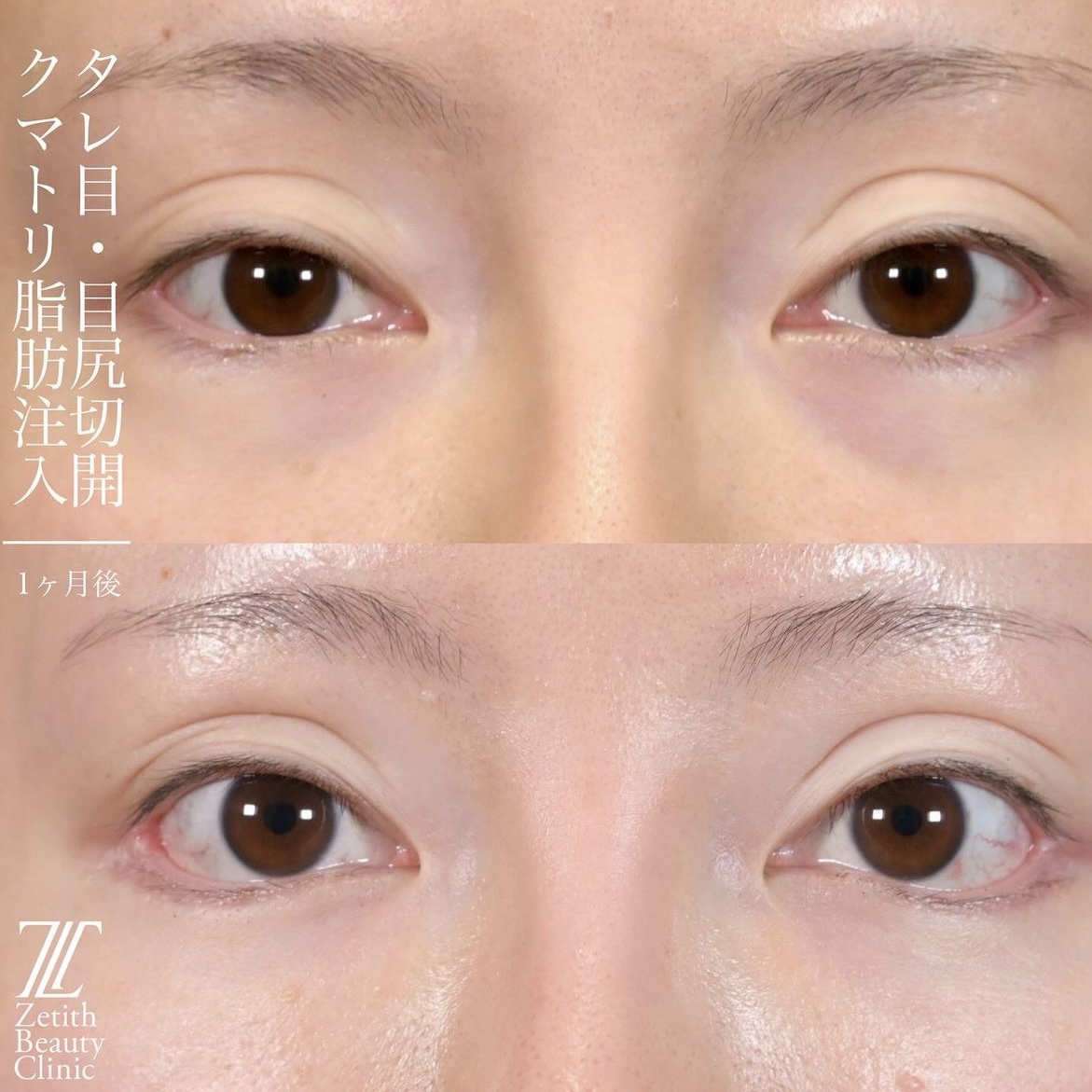 上木原医師による目元整形の術前/術後1ヶ月