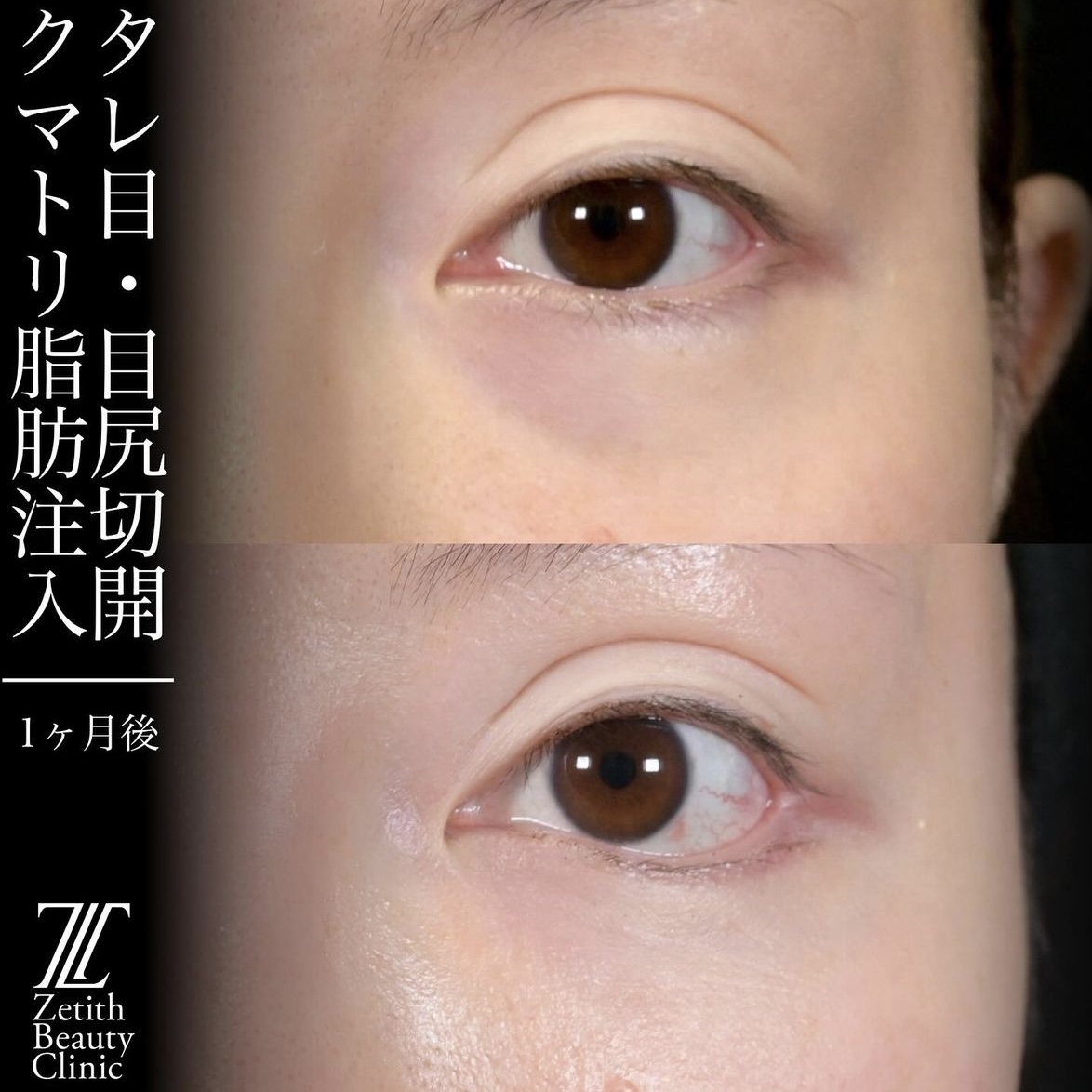 上木原医師による目元整形の術前/術後1ヶ月 Sau 