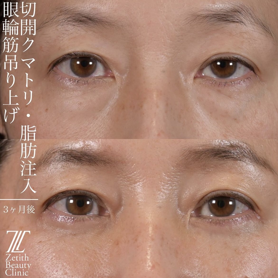上木原医師による目元整形の術前/術後3ヶ月