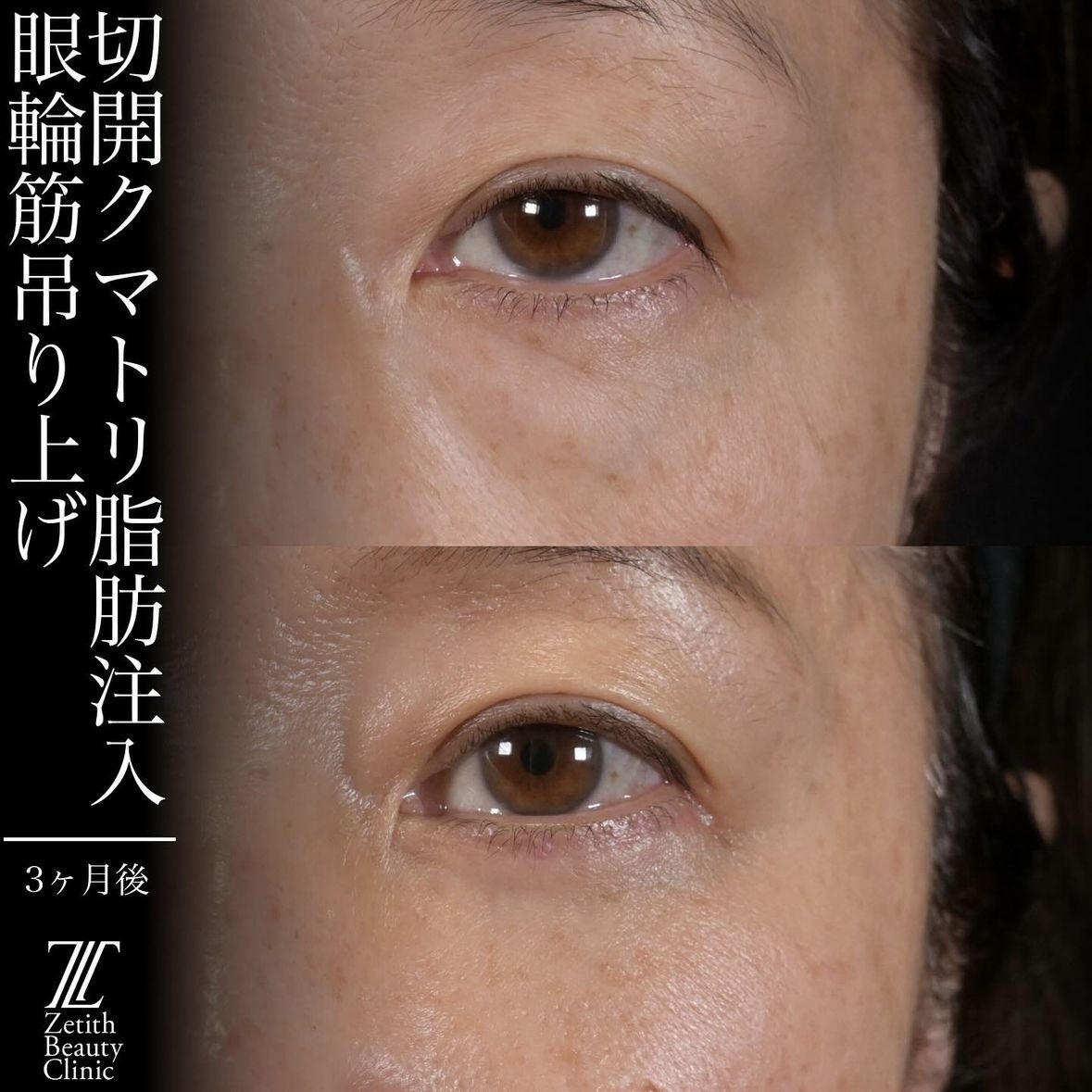 上木原医師による目元整形の術前/術後3ヶ月 术后 