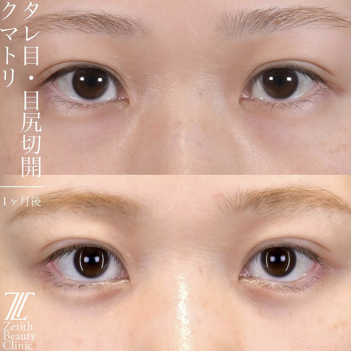 上木原医師による目元整形の術前/術後1ヶ月