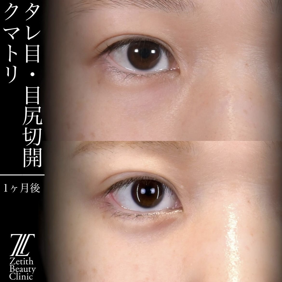 上木原医師による目元整形の術前/術後1ヶ月 术后 