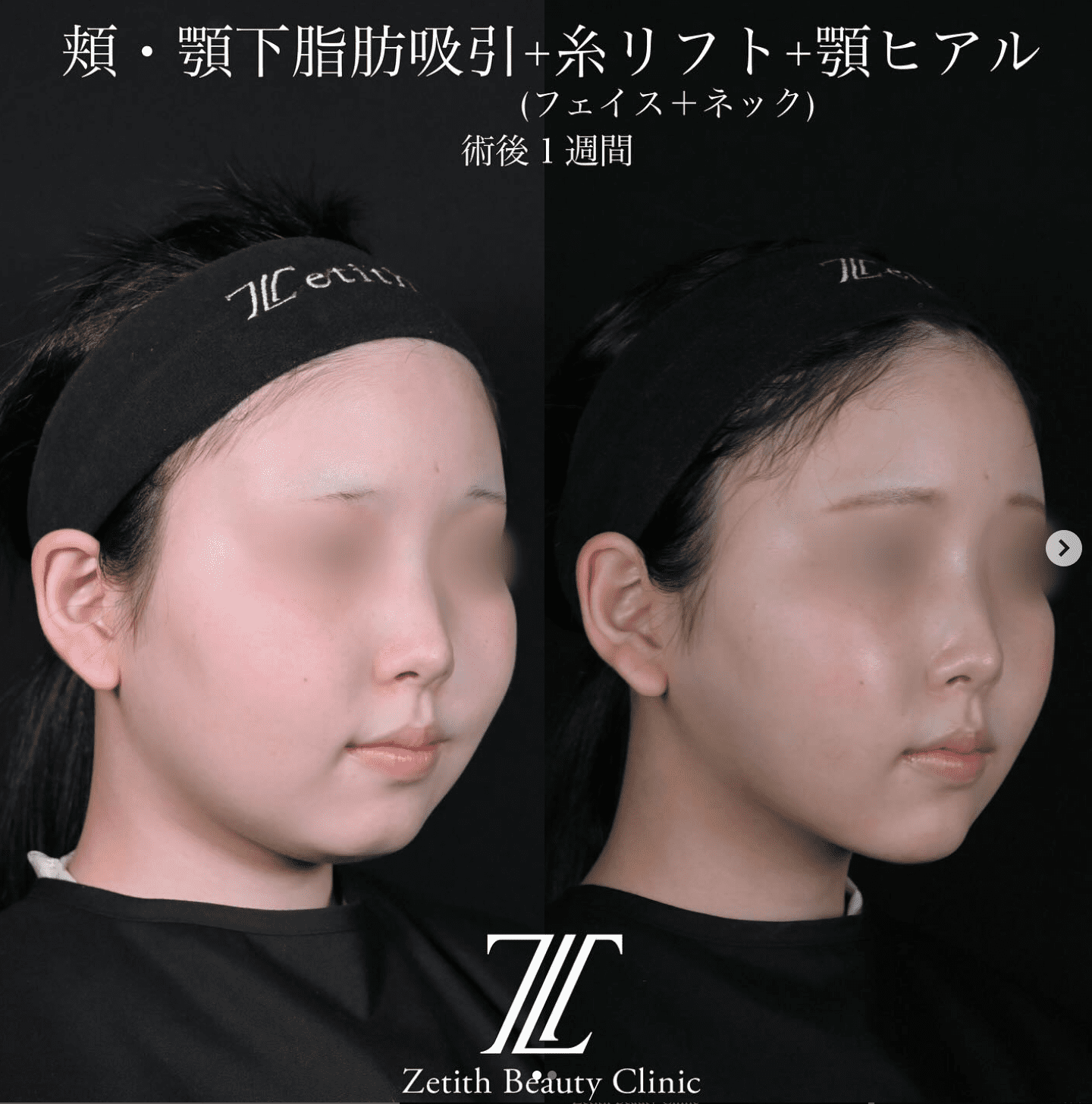 北村医師による脂肪吸引リフトの施術前/術後1ヶ月