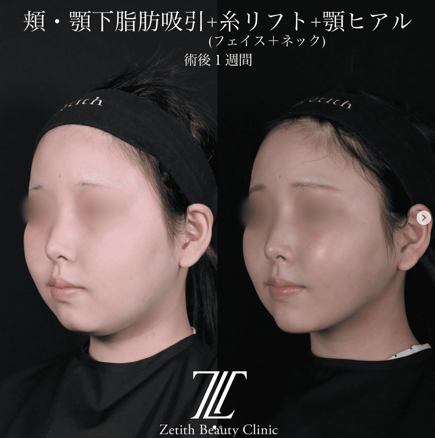 北村医師による脂肪吸引リフトの施術前/術後1ヶ月 施術後 