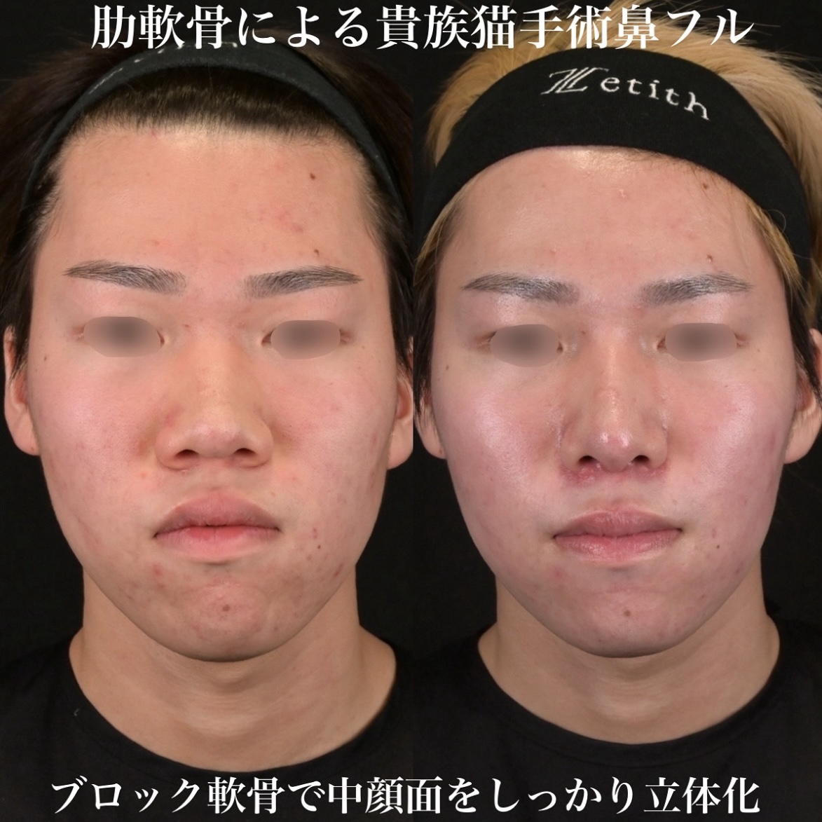 鉄医師による鼻整形の術前/術後3ヶ月