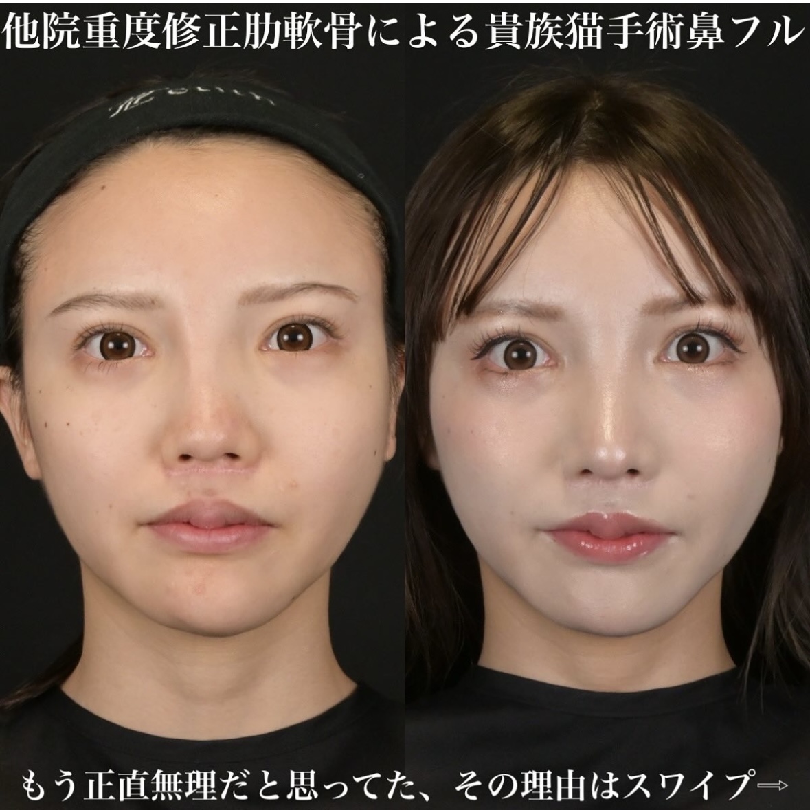 鉄医師による鼻整形の術前/術後3ヶ月