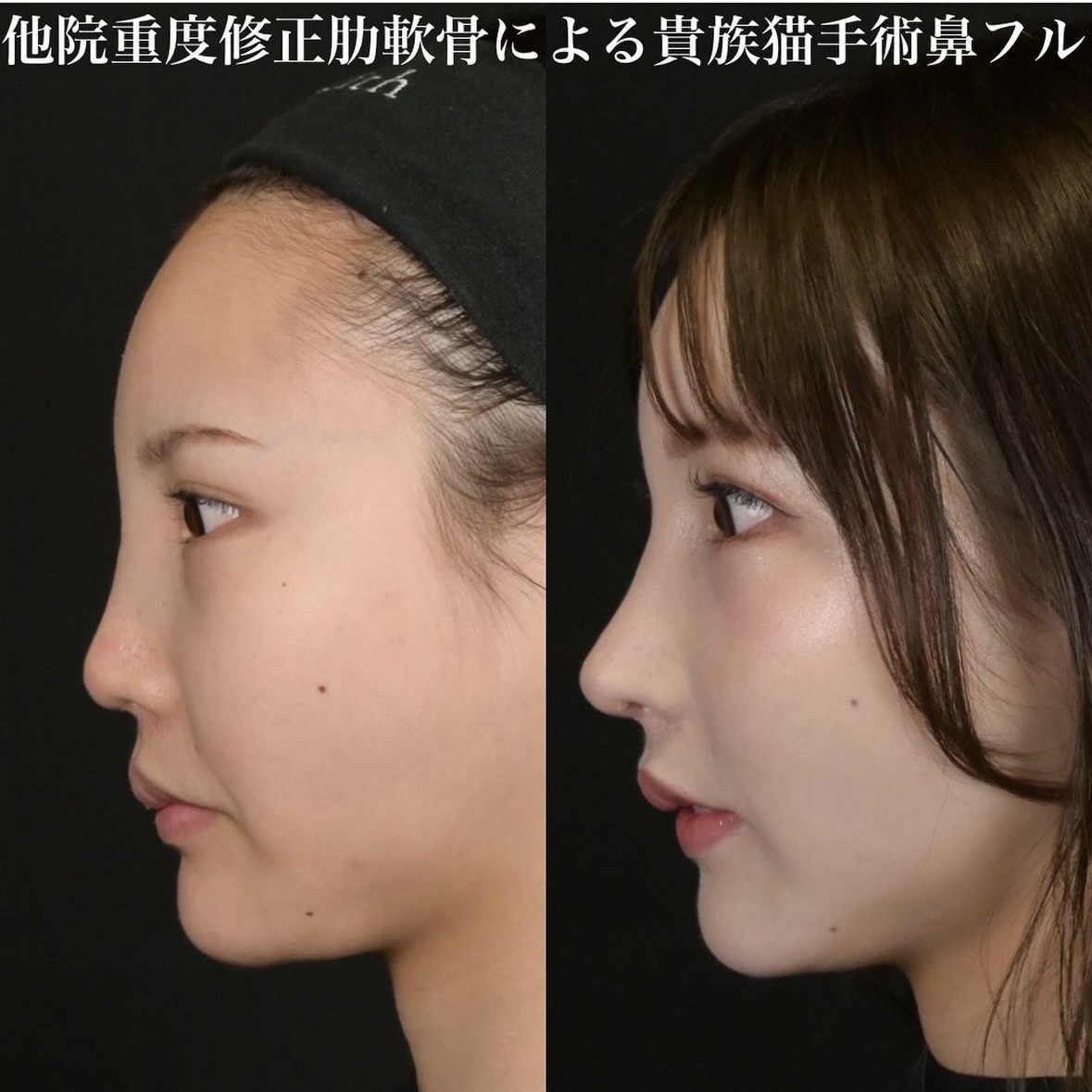 鉄医師による鼻整形の術前/術後3ヶ月 术后 