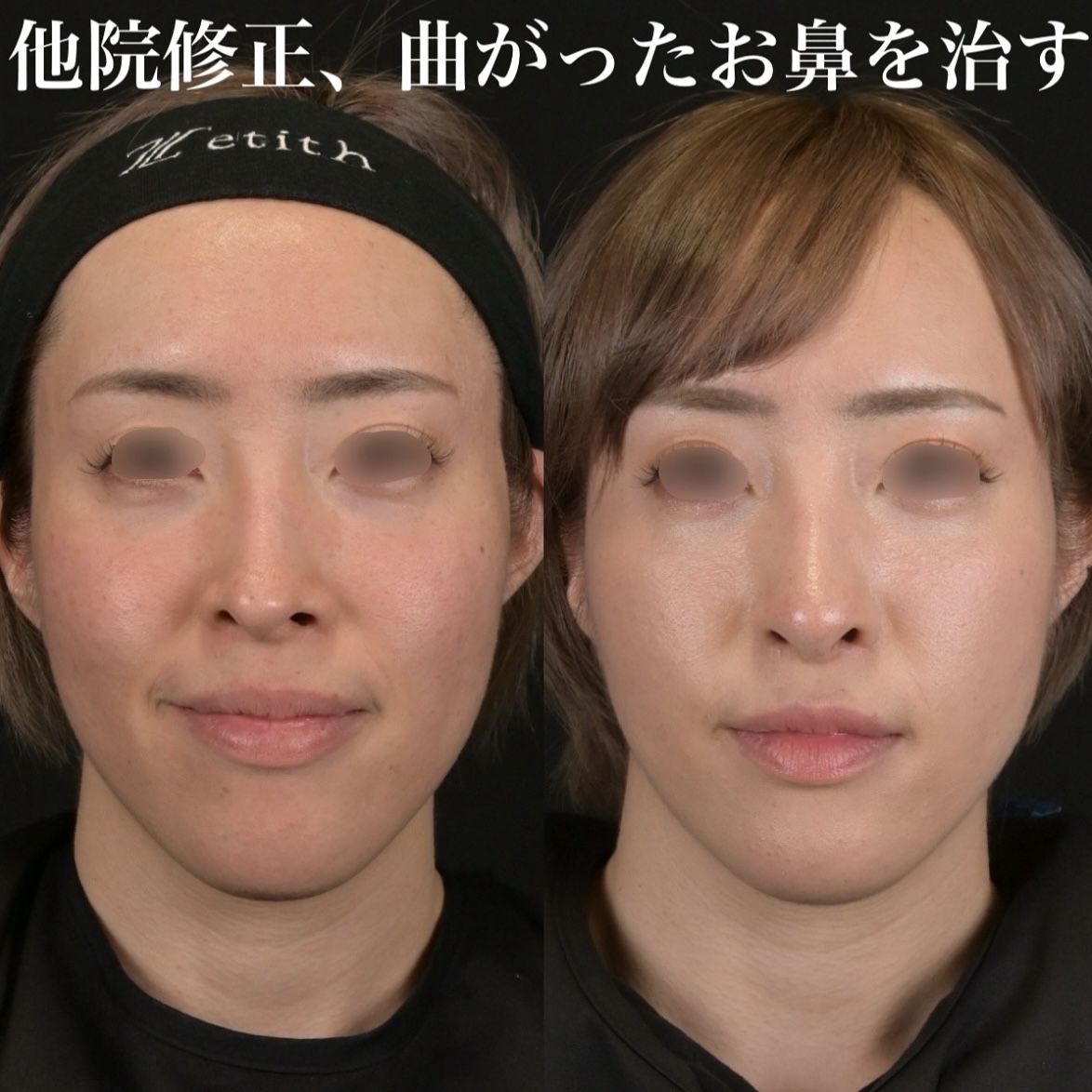 鉄医師による鼻整形の術前/術後1ヶ月