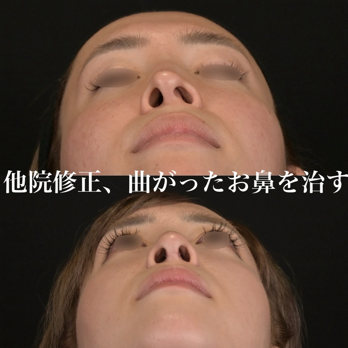 鉄医師による鼻整形の術前/術後1ヶ月 Дараа 