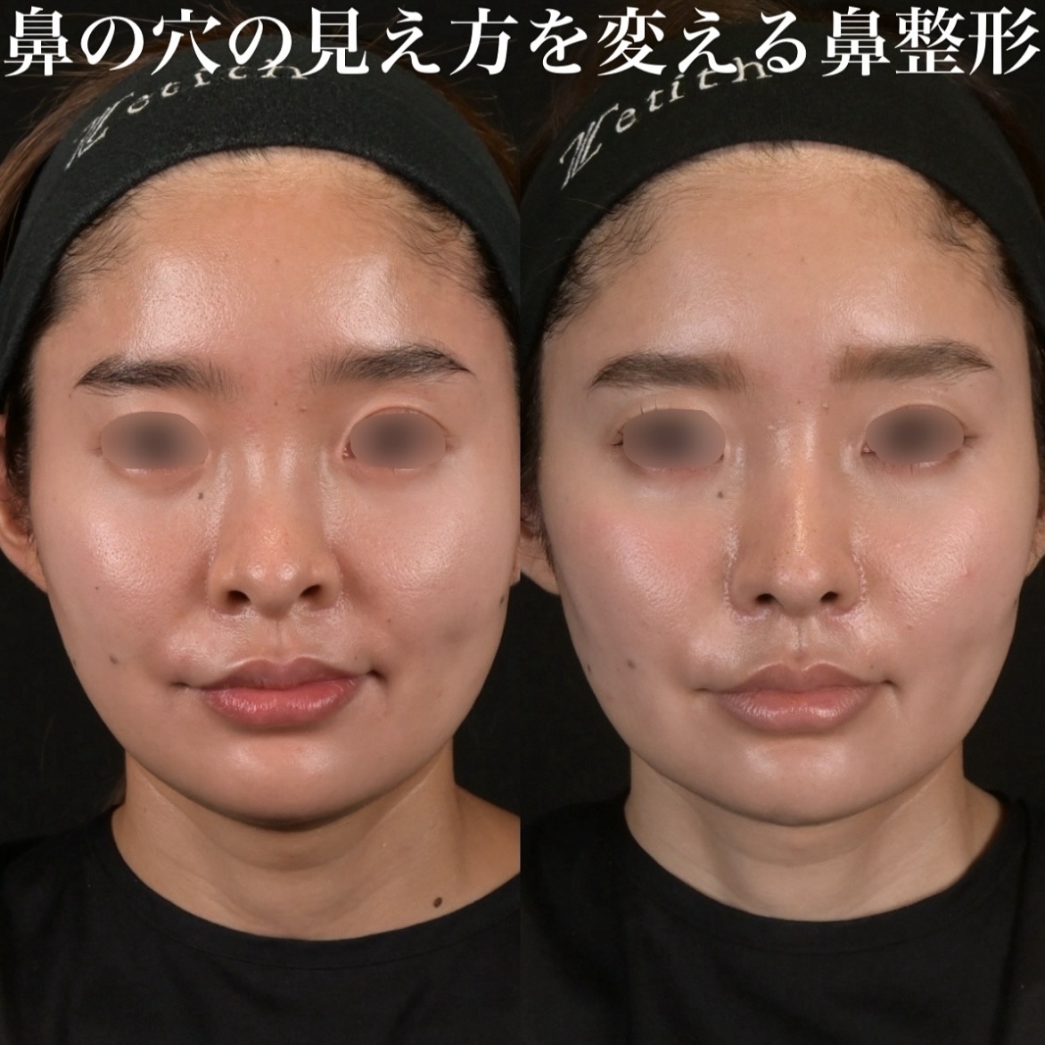 鉄医師による鼻整形の術前/術後6ヶ月
