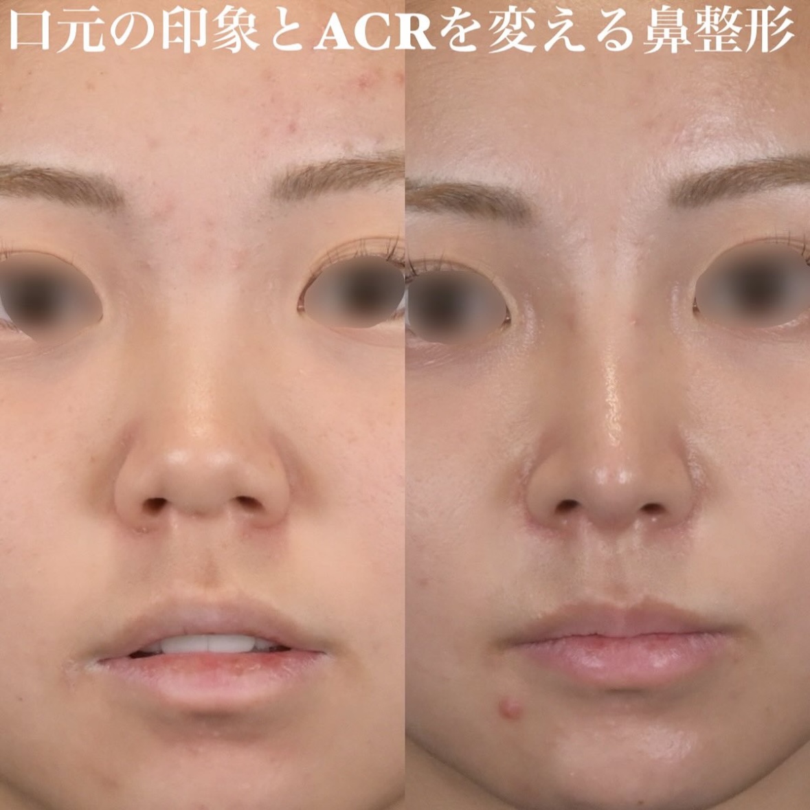 鉄医師による鼻整形の術前/術後3ヶ月