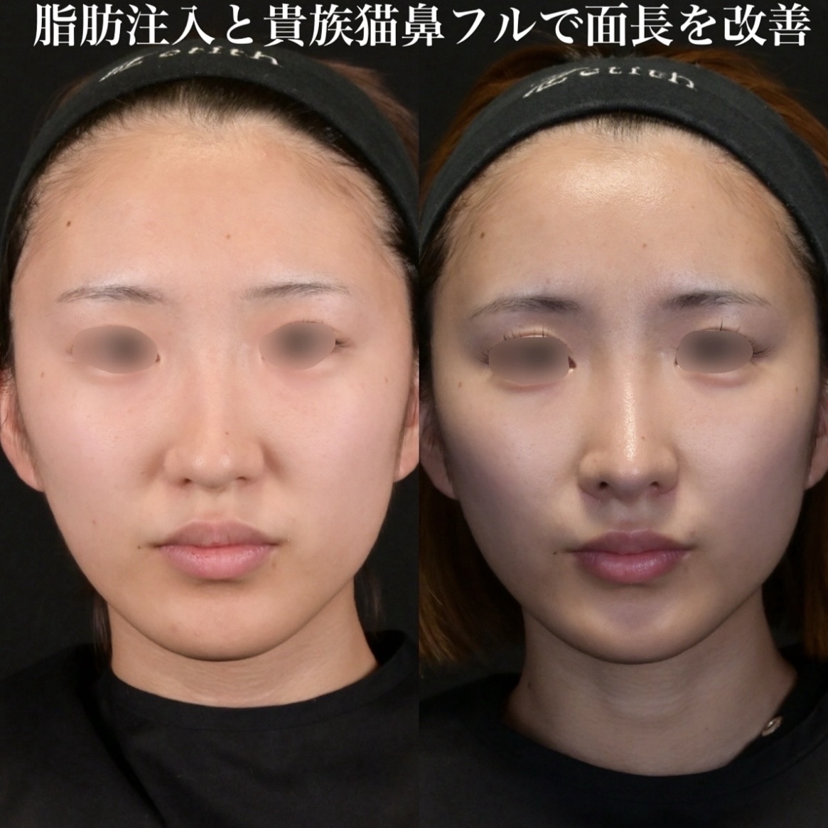 鉄医師による鼻整形の術前/術後3ヶ月