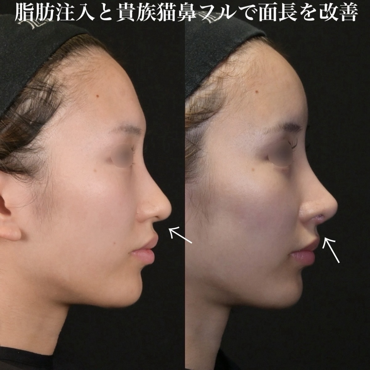 鉄医師による鼻整形の術前/術後3ヶ月 After 