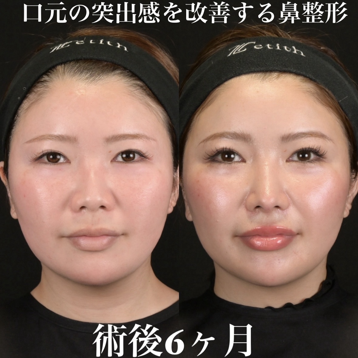 鉄医師による鼻整形の術前/術後6ヶ月