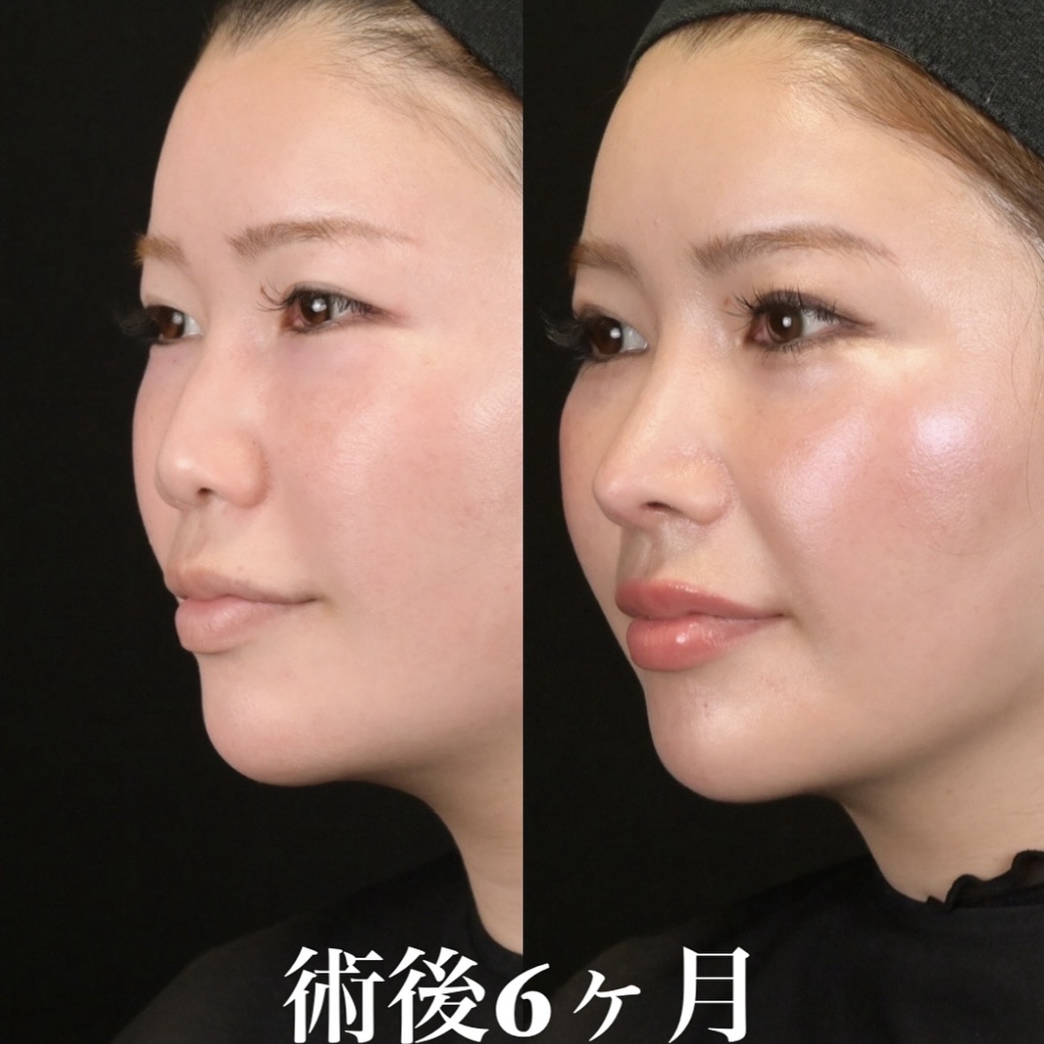 鉄医師による鼻整形の術前/術後6ヶ月 施術後 