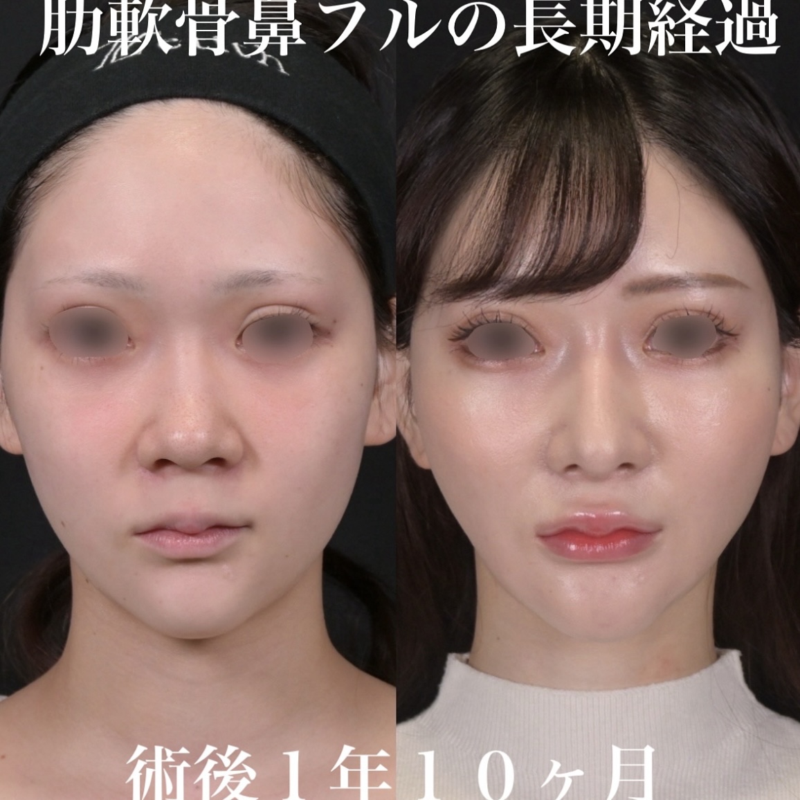 鉄医師による鼻整形の術前/術後1年10ヶ月