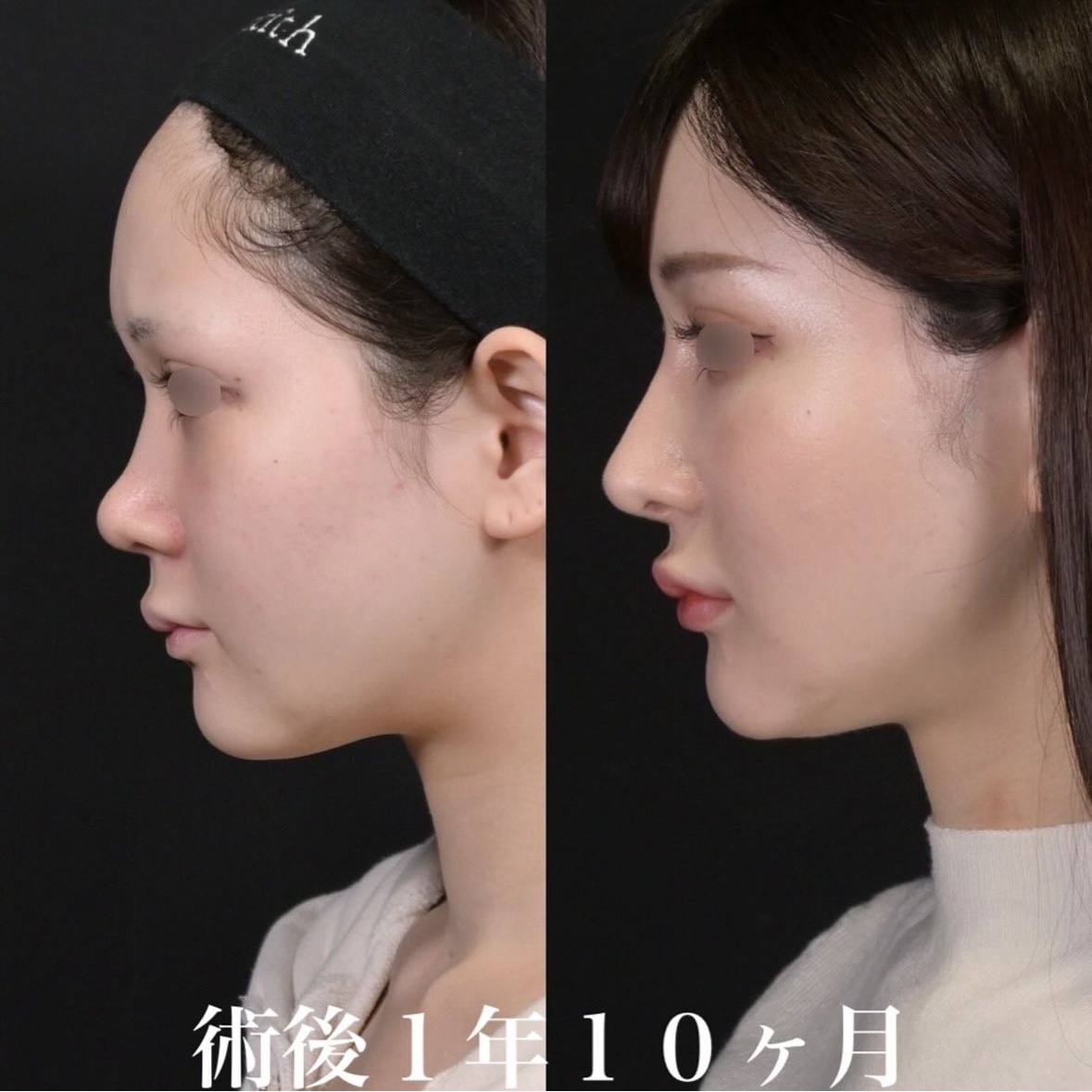 鉄医師による鼻整形の術前/術後1年10ヶ月 หลัง 