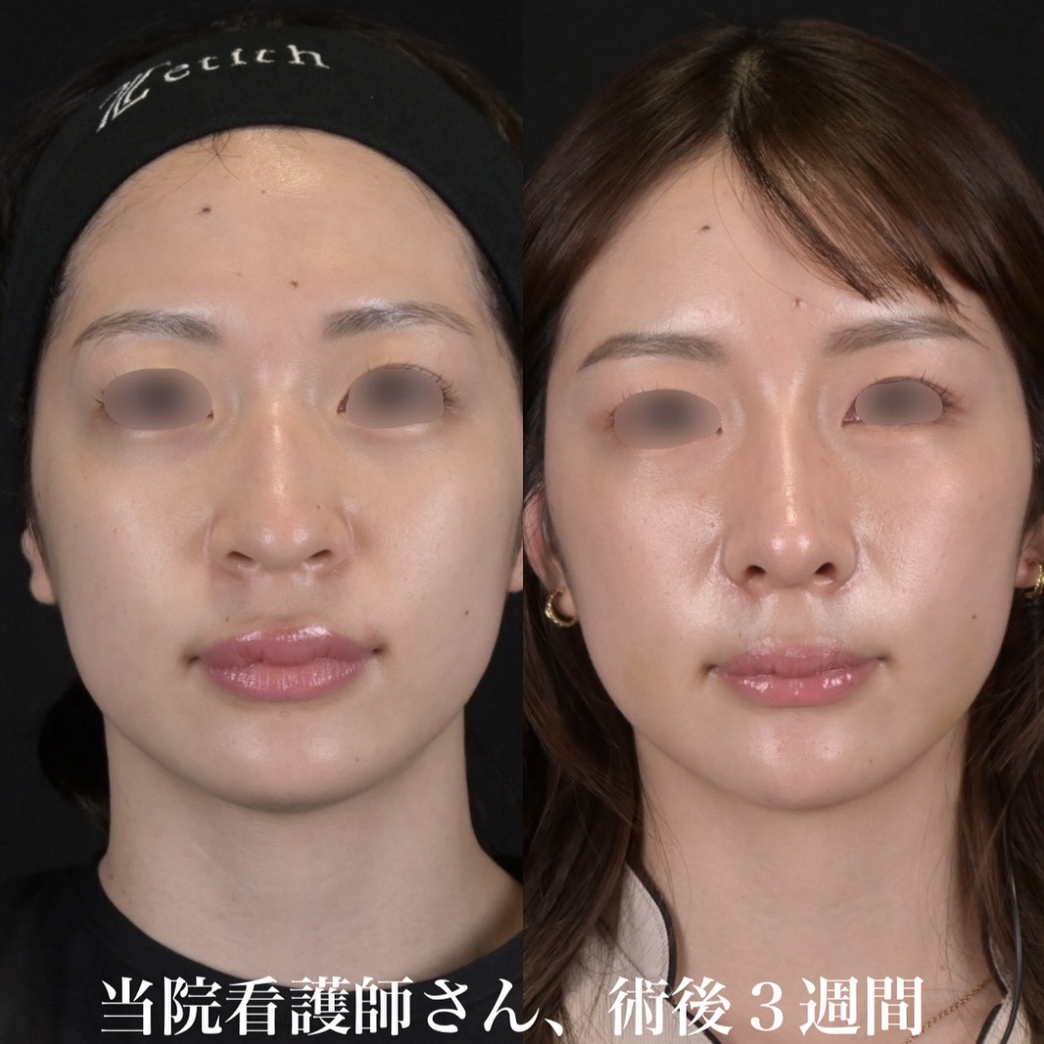 鉄医師による鼻整形の術前/術後3週間