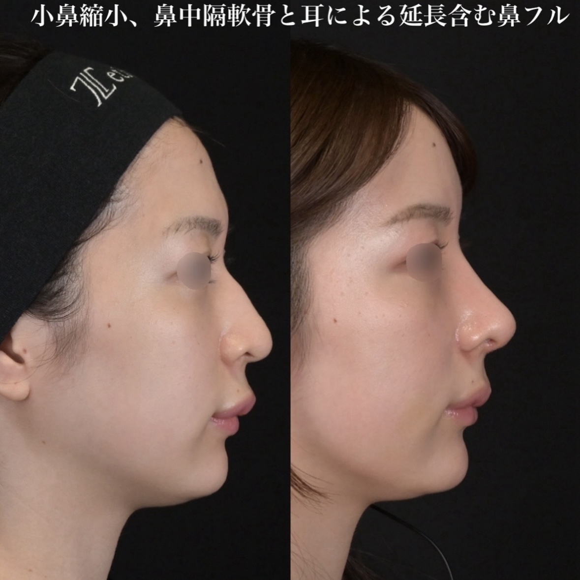 鉄医師による鼻整形の術前/術後3週間 施術後 