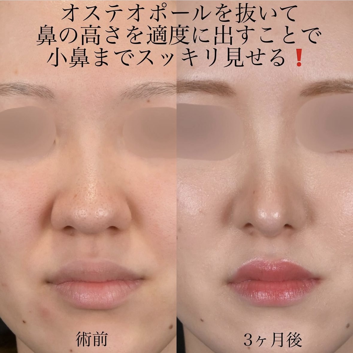 上木原医師による鼻整形の術前/術後3ヶ月