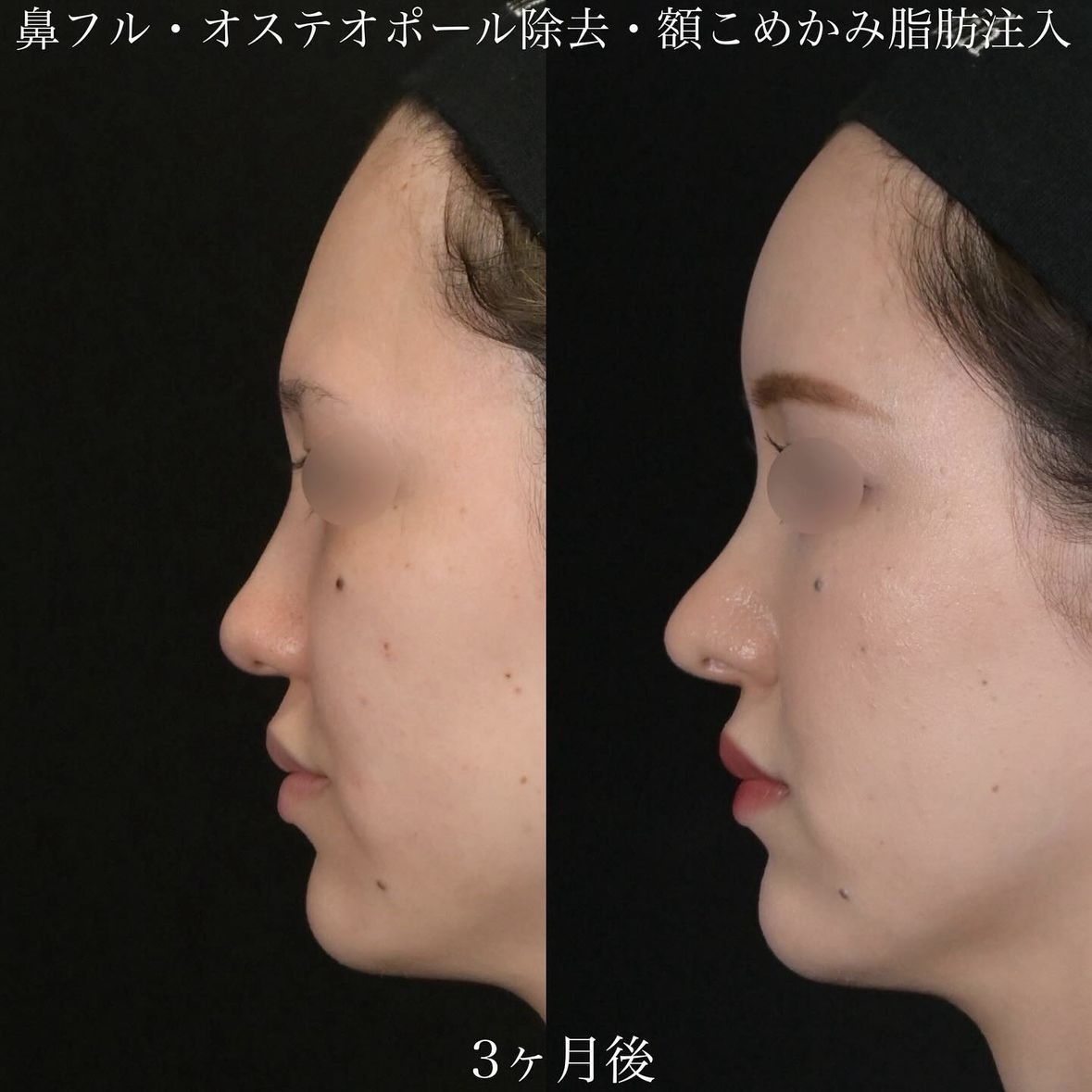 上木原医師による鼻整形の術前/術後3ヶ月 Дараа 