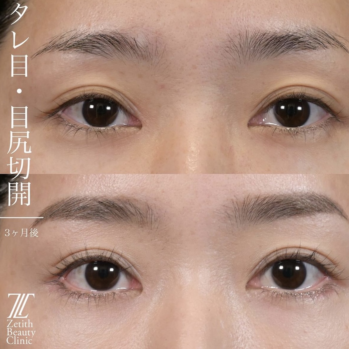 上木原医師による目元整形の術前/術後3ヶ月