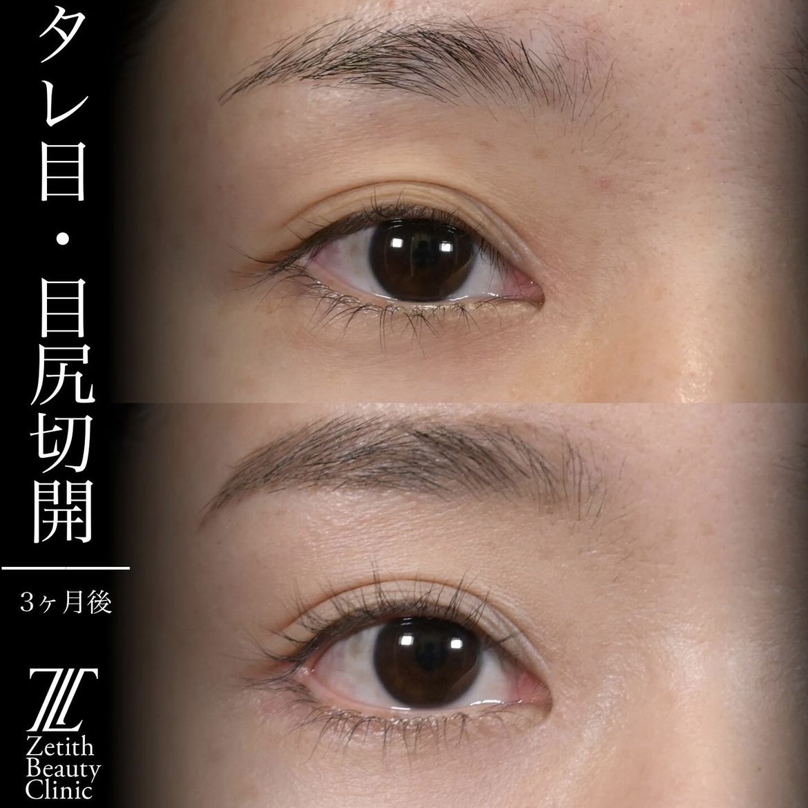 上木原医師による目元整形の術前/術後3ヶ月 Дараа 