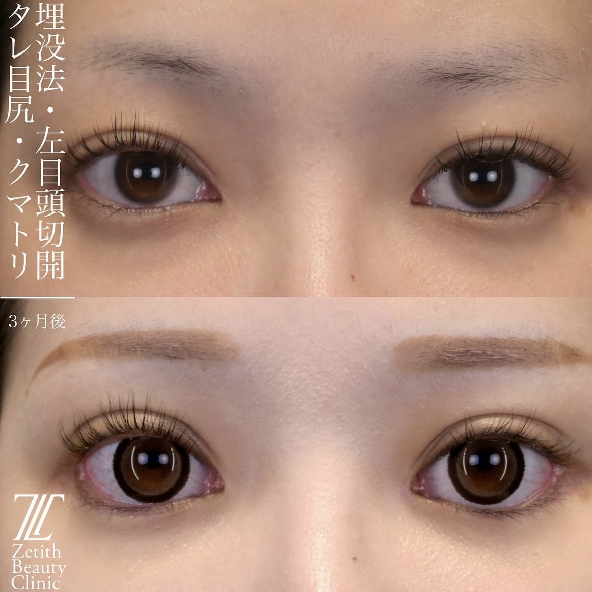 上木原医師による目元整形の術前/術後1ヶ月