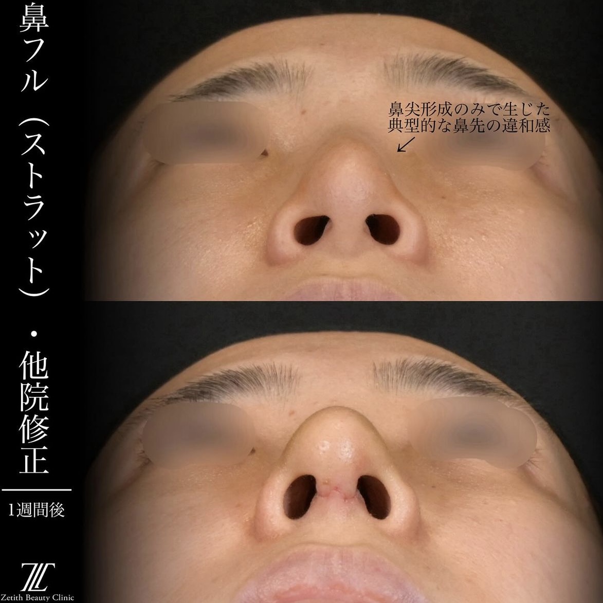 上木原医師による鼻整形の術前/術後1週間