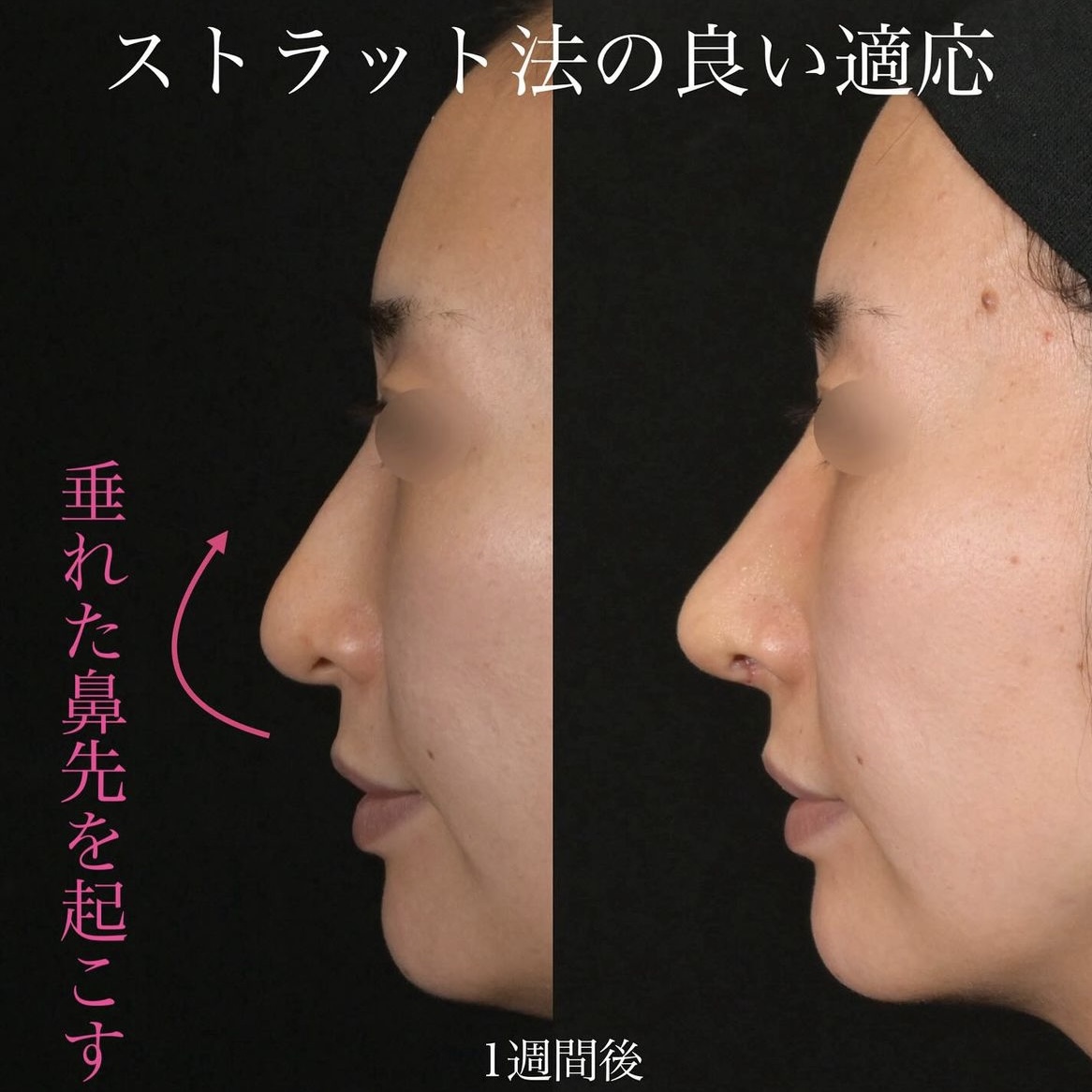 上木原医師による鼻整形の術前/術後1週間 施術後 