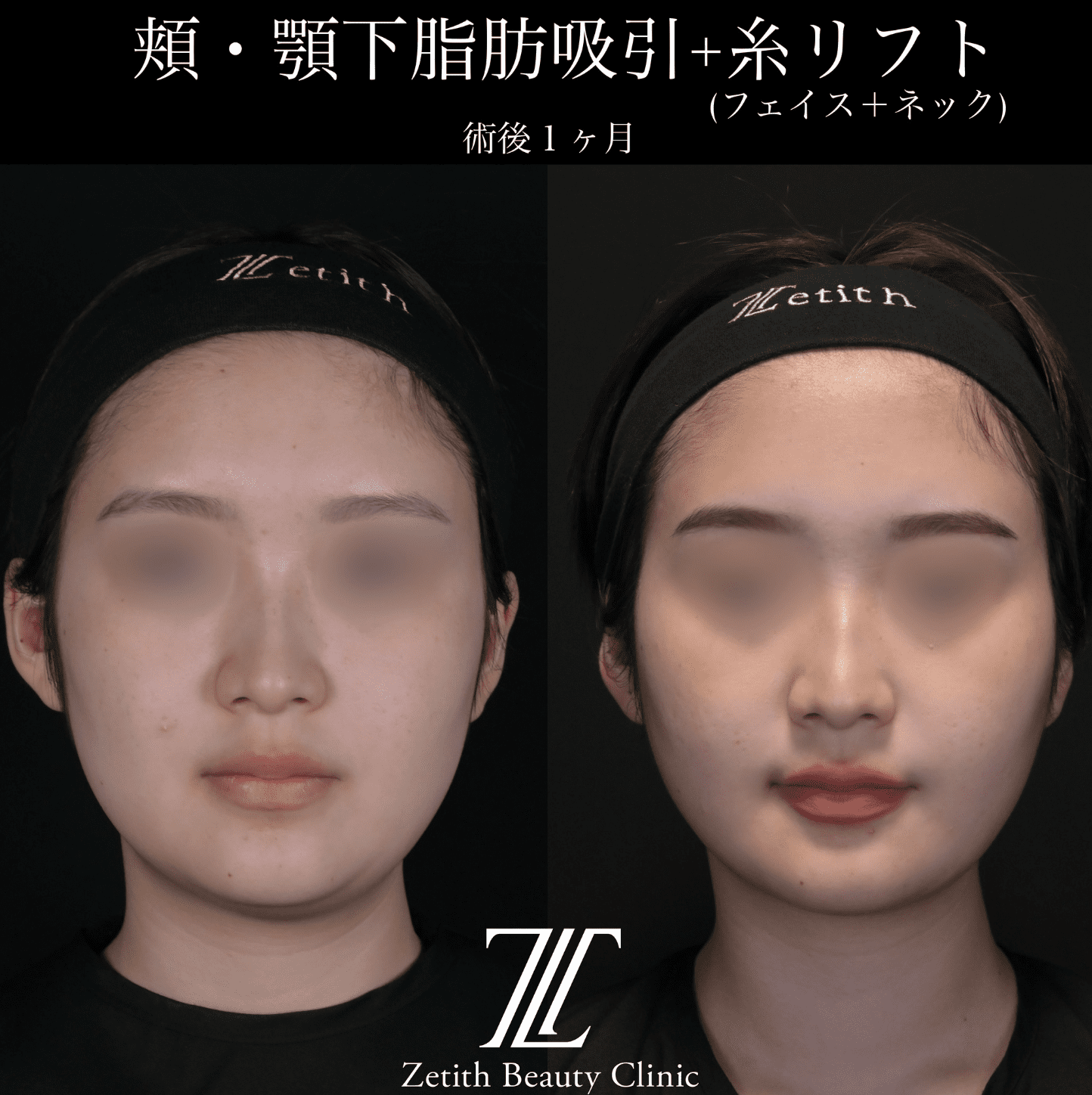 北村医師による脂肪吸引リフトの施術前／術後1ヶ月