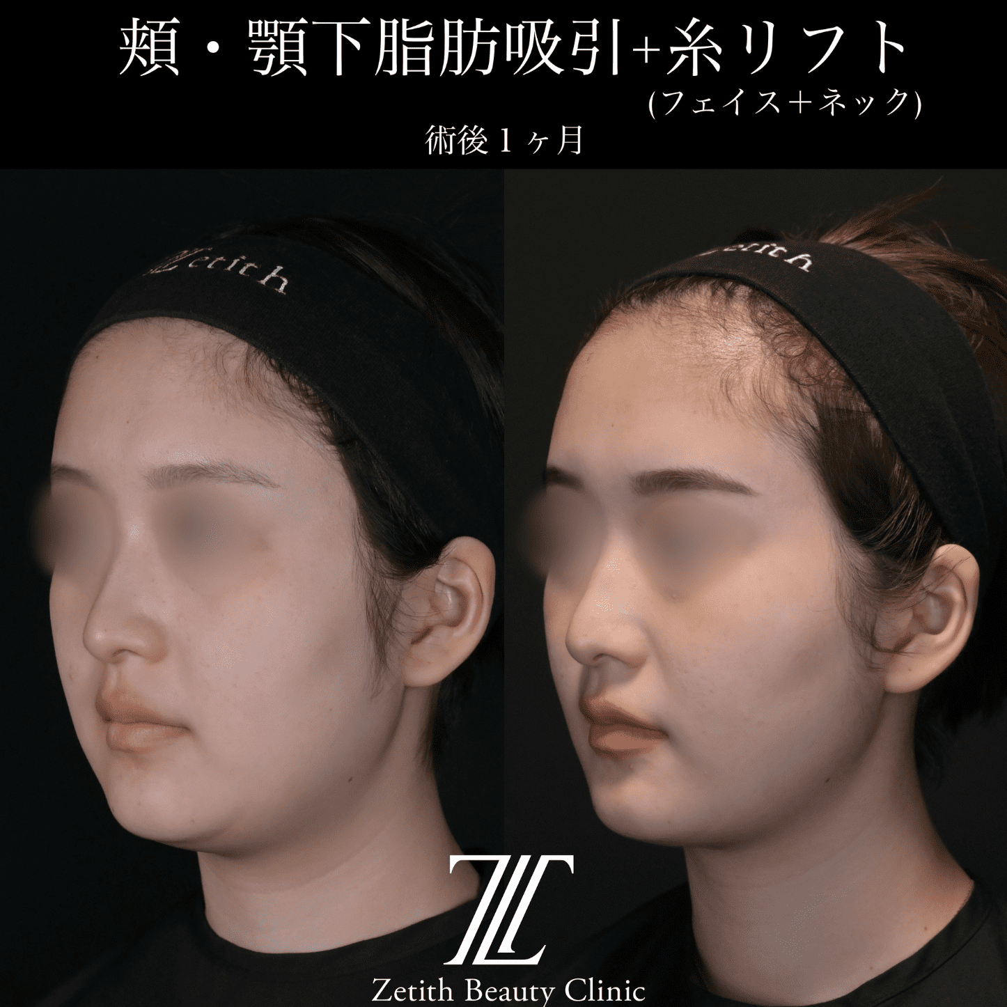 北村医師による脂肪吸引リフトの施術前／術後1ヶ月 Дараа 