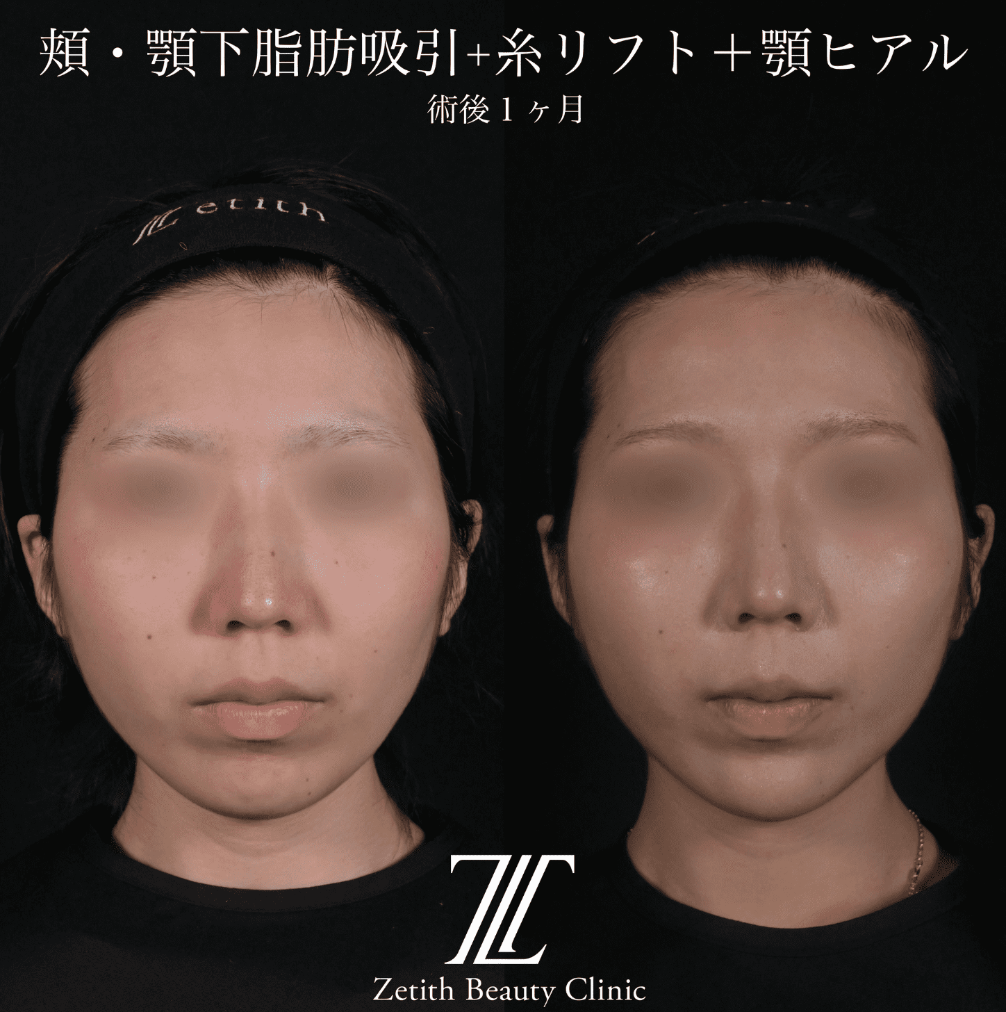 北村医師による脂肪吸引リフトの施術前／術後1ヶ月