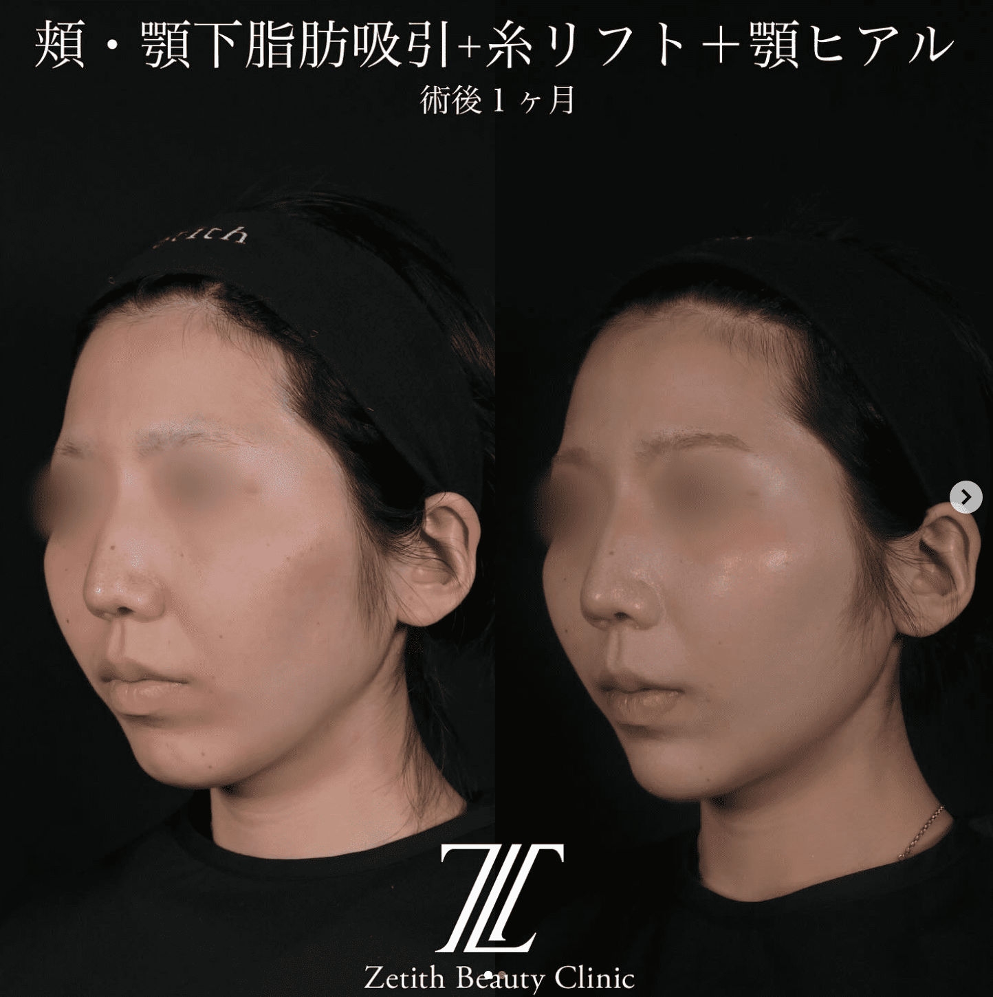 北村医師による脂肪吸引リフトの施術前／術後1ヶ月 หลัง 