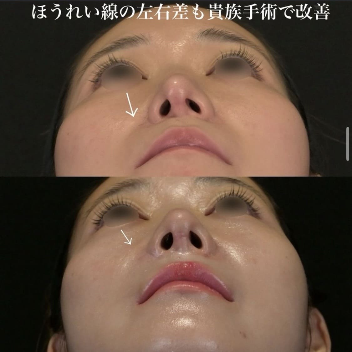 鉄医師による鼻整形の術前/術後１ヶ月 หลัง 
