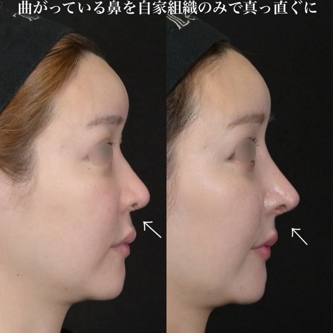 鉄医師による鼻整形の術前/術後１ヶ月 施術後 