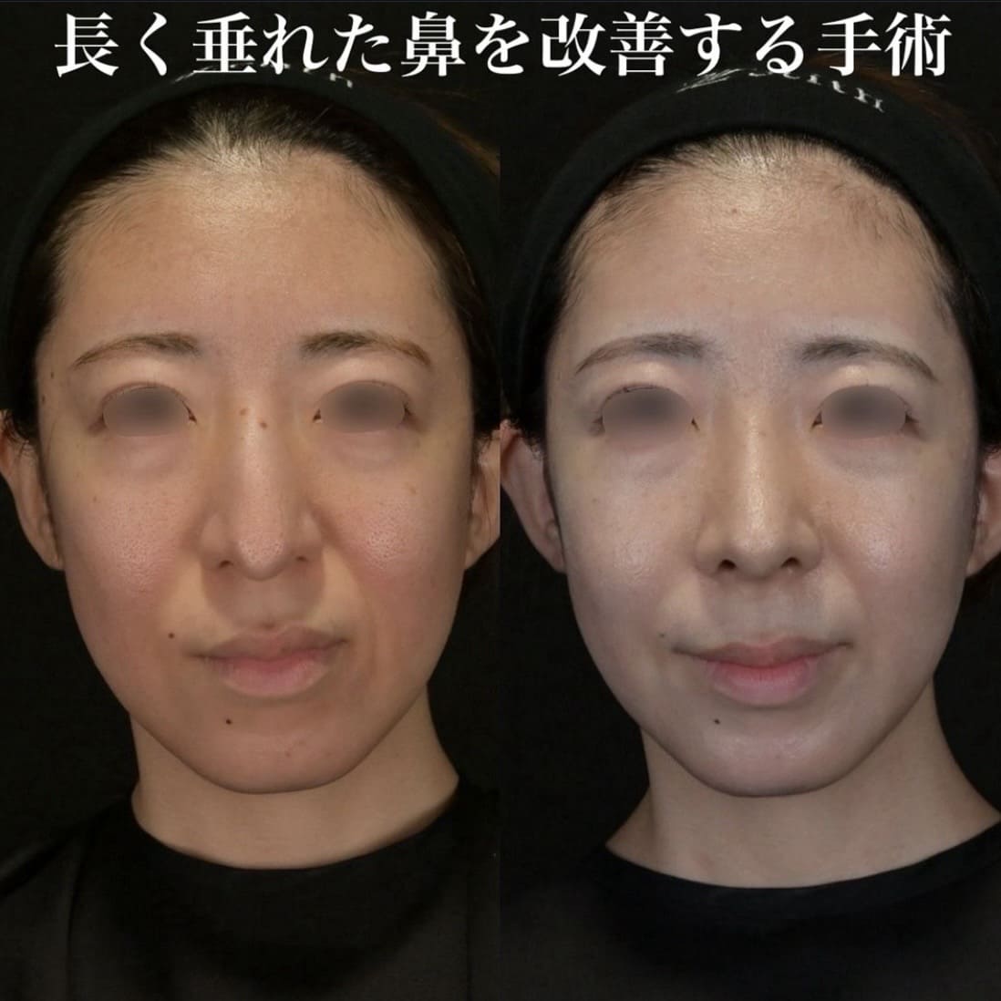 鉄医師による鼻整形の術前/術後１ヶ月 Дараа 