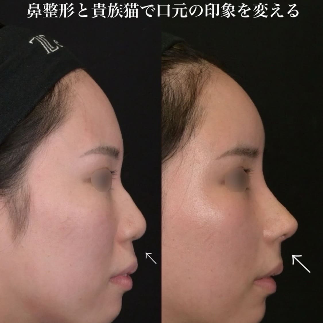 鉄医師による鼻整形の術前/術後２週間 术后 