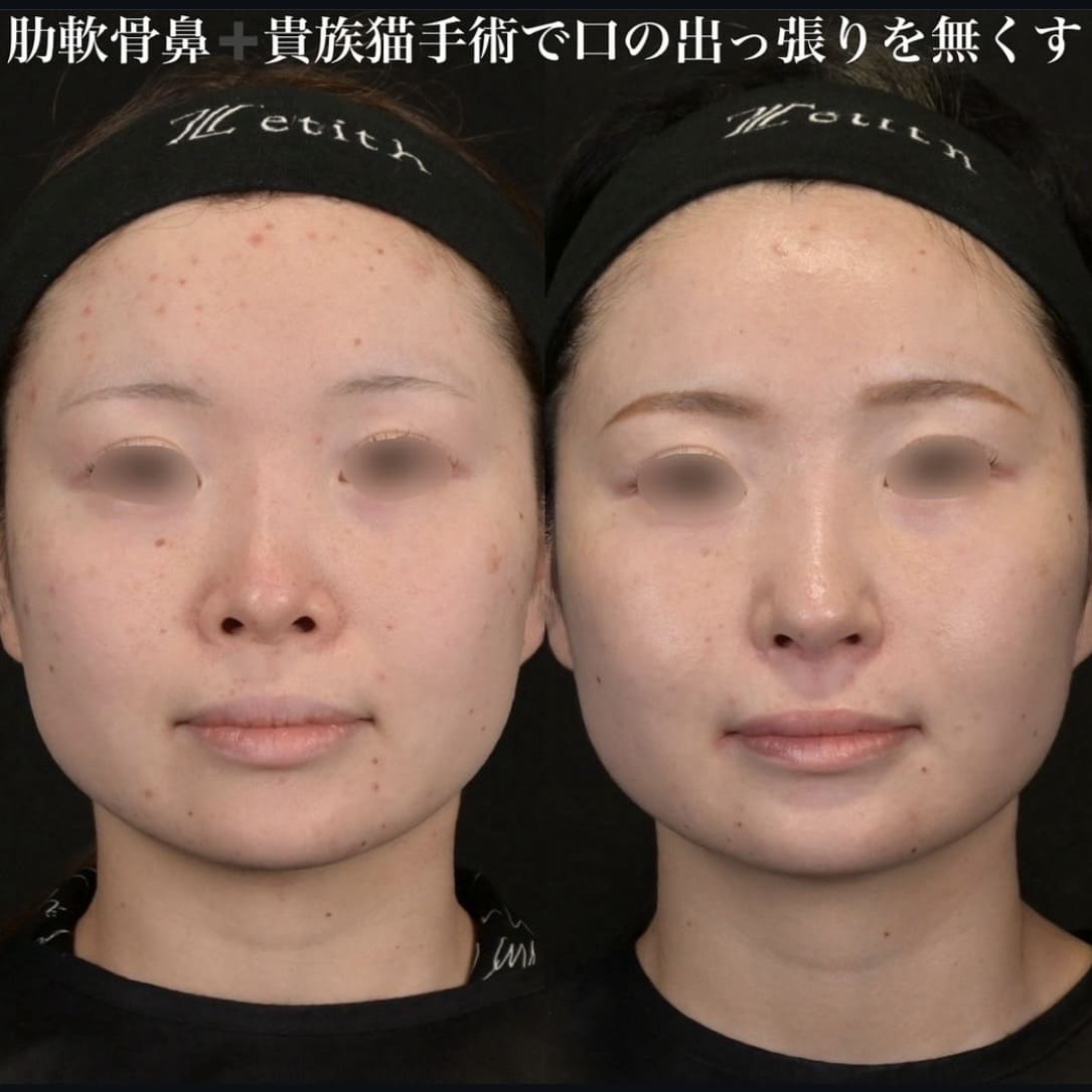 鉄医師による鼻整形の術前/術後6ヶ月
