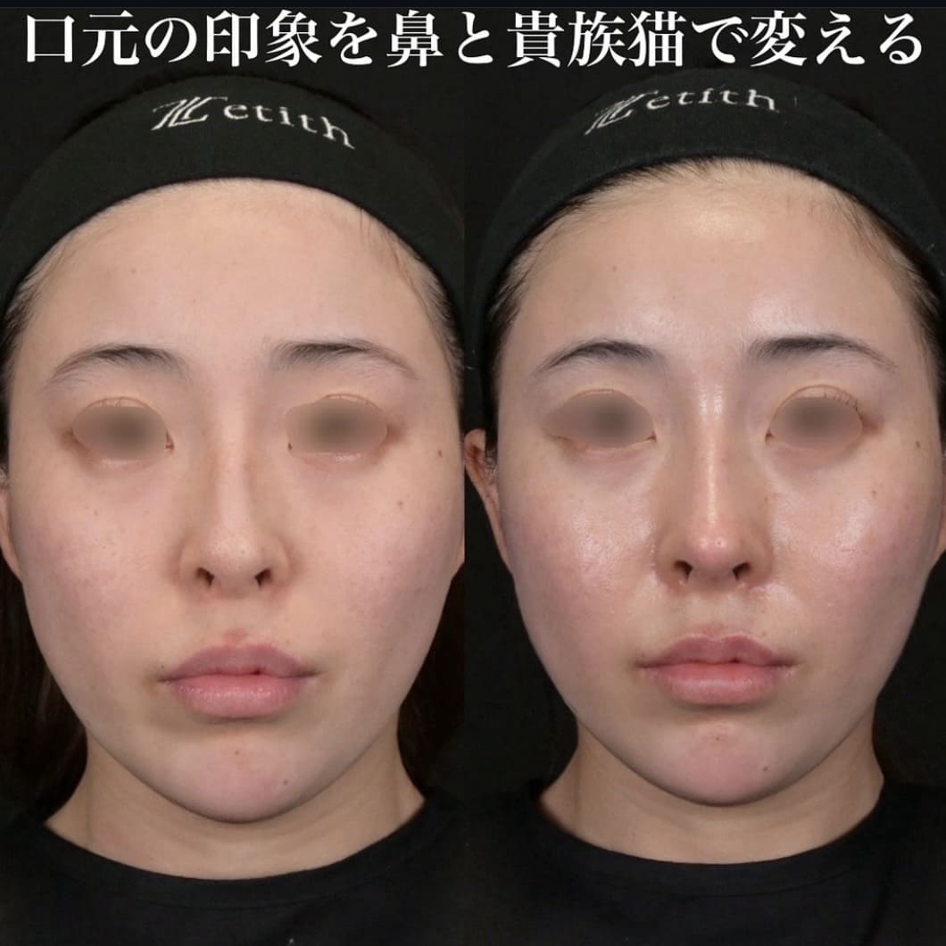 鉄医師による鼻整形の術前/術後１ヶ月