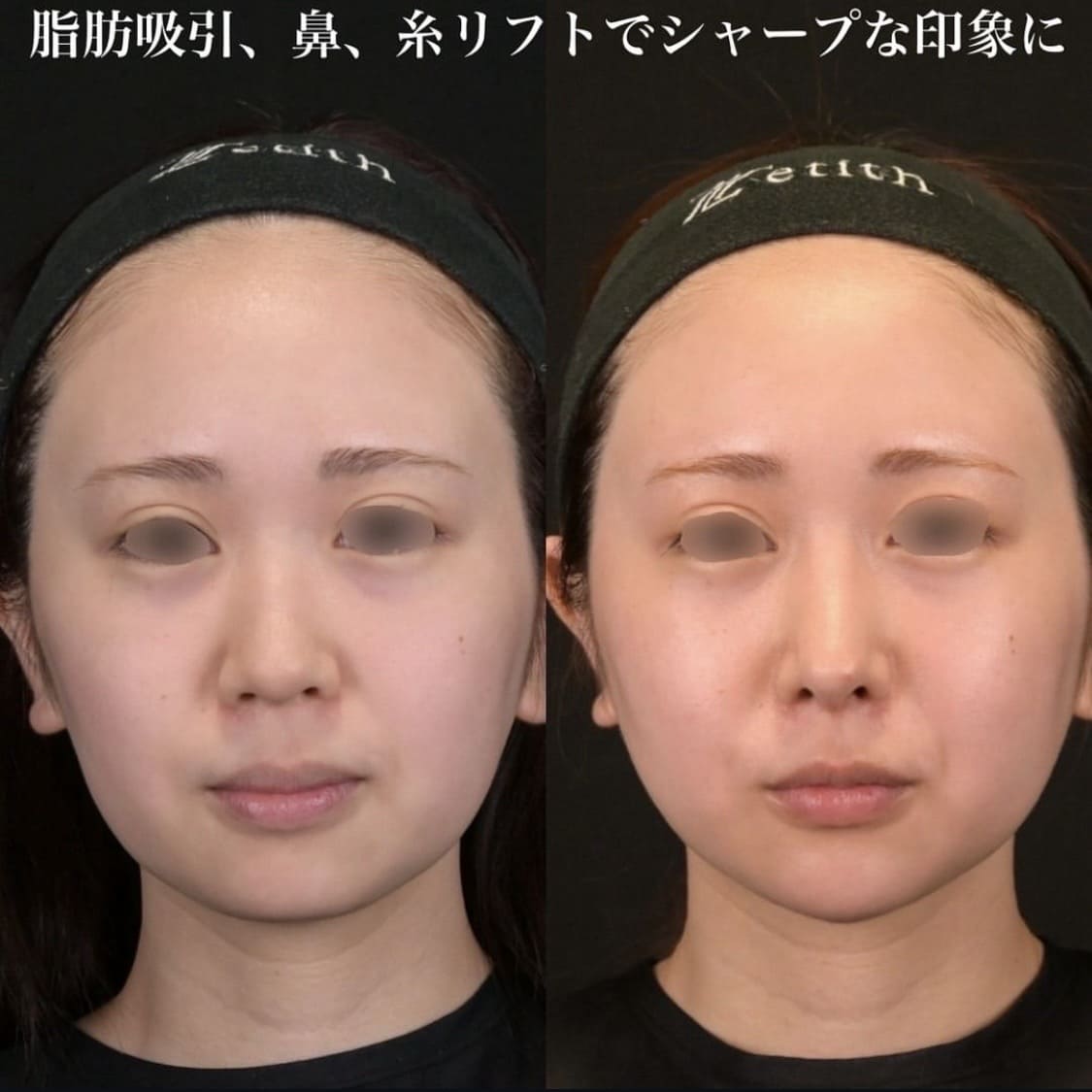 鉄医師による鼻整形の術前/術後6ヶ月