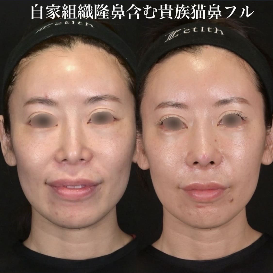 鉄医師による鼻整形の術前/術後1ヶ月