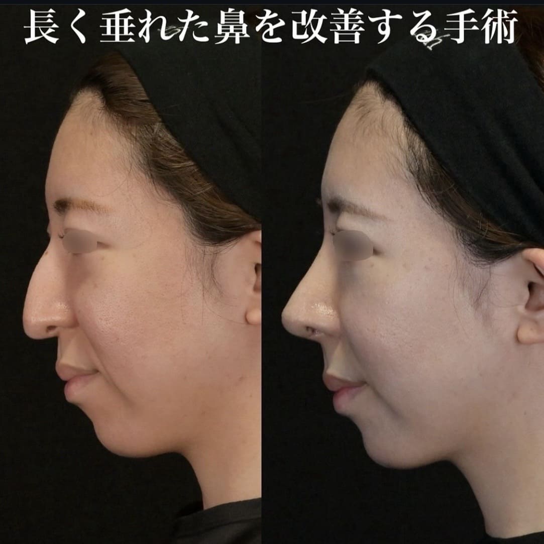 鉄医師による鼻整形の術前/術後１ヶ月