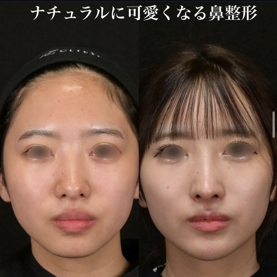鉄医師による鼻整形の術前/術後６ヶ月