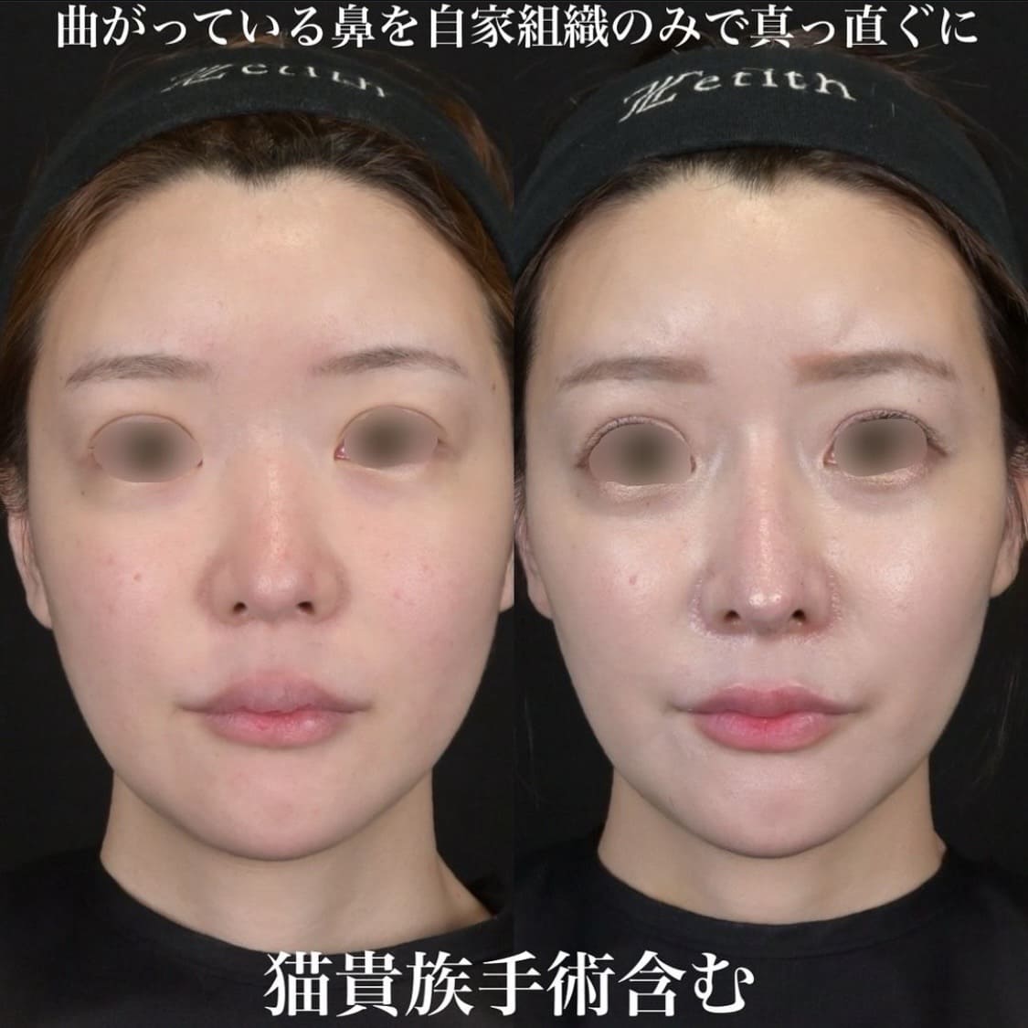 鉄医師による鼻整形の術前/術後１ヶ月