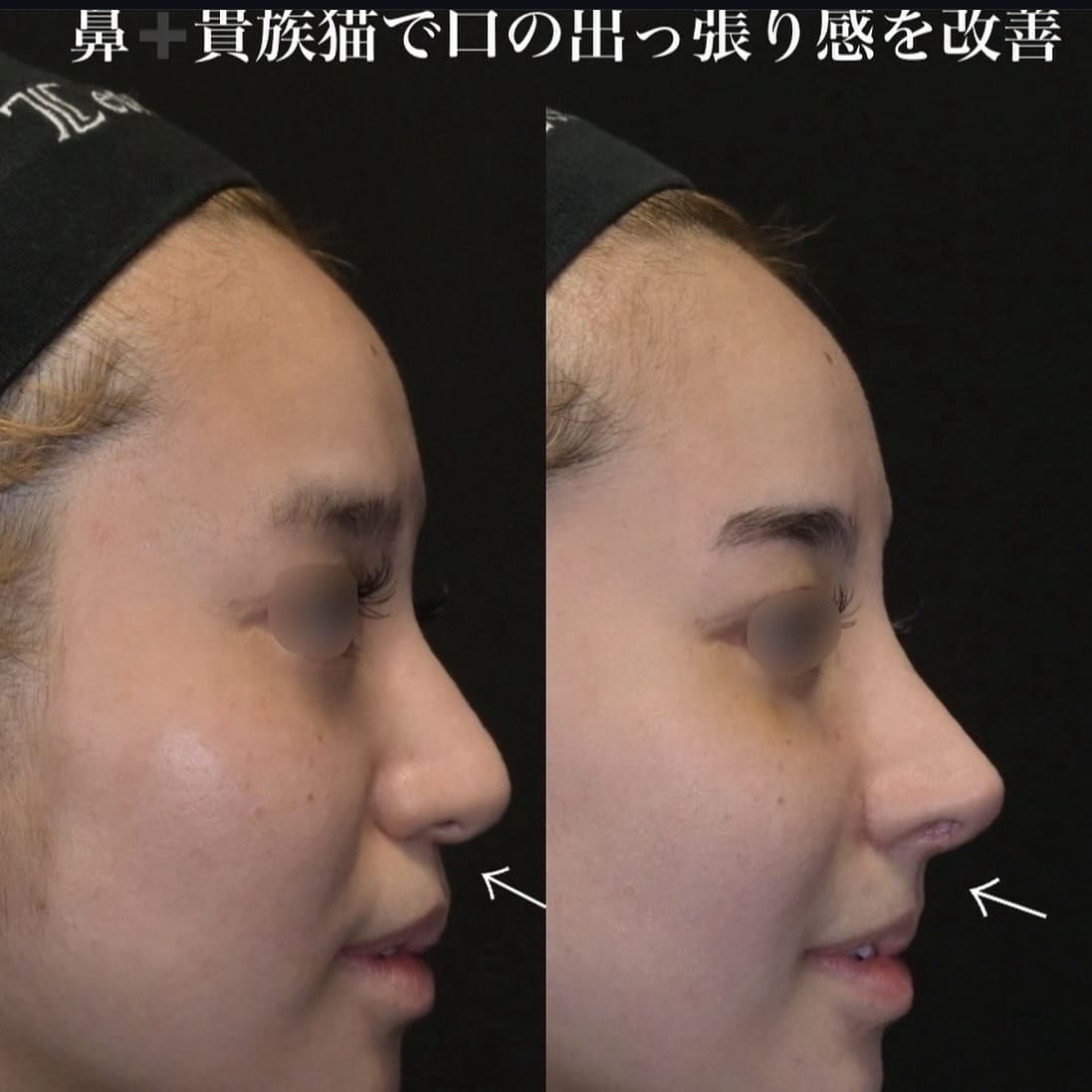 鉄医師による鼻整形の術前/術後２週間 After 