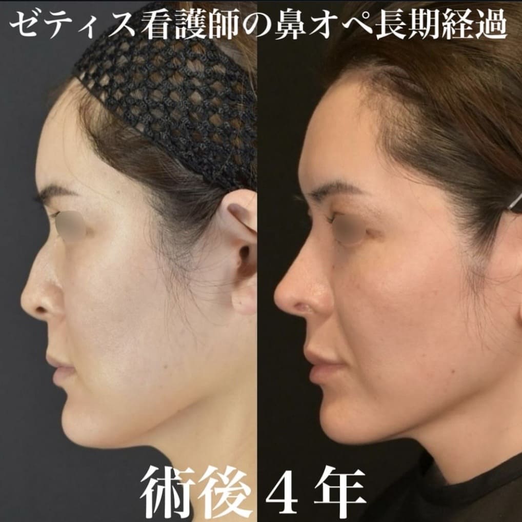 鉄医師による鼻整形の術前/術後4年 หลัง 