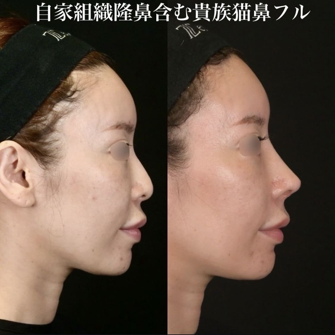 鉄医師による鼻整形の術前/術後1ヶ月 Дараа 