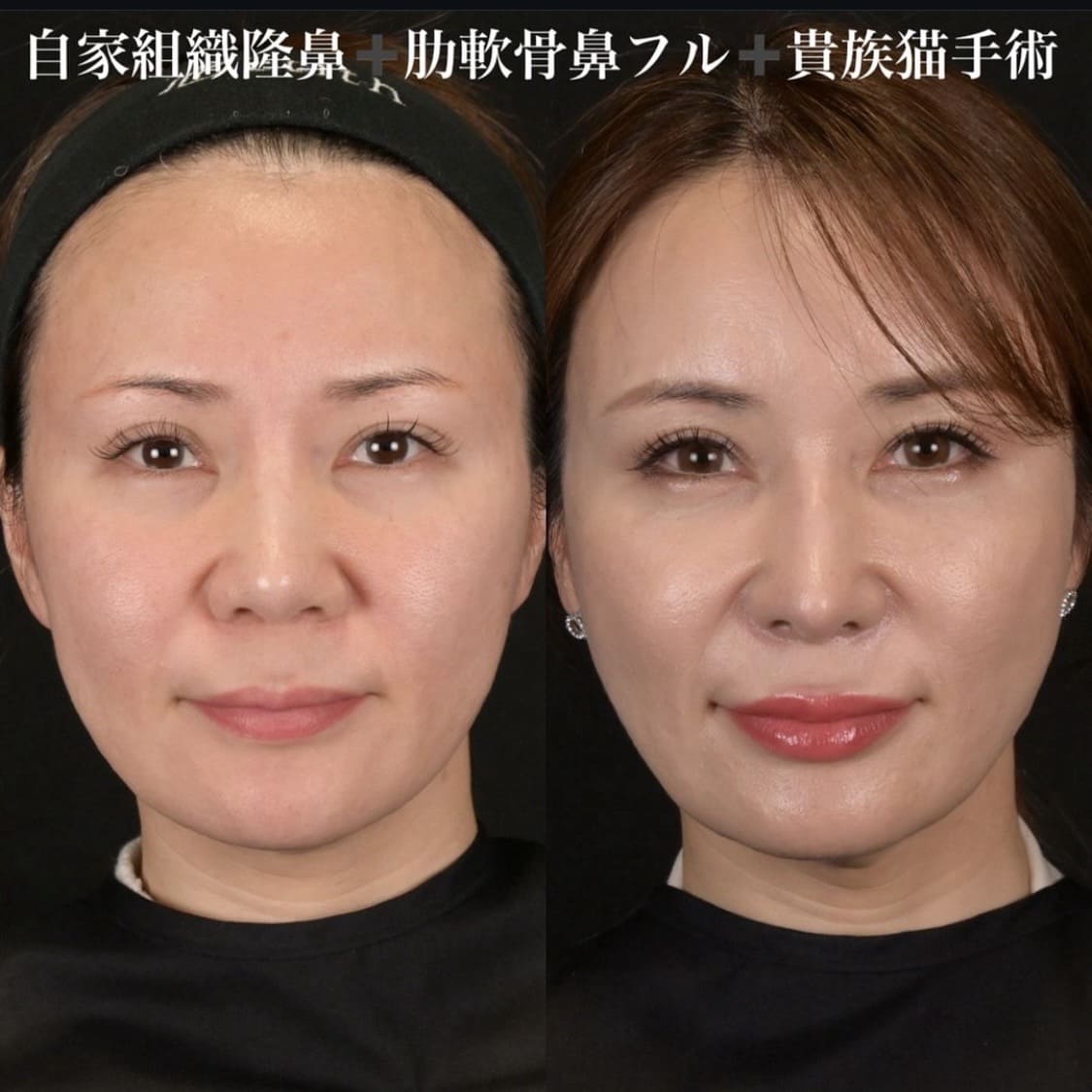 鉄医師による鼻整形の術前/術後３ヶ月
