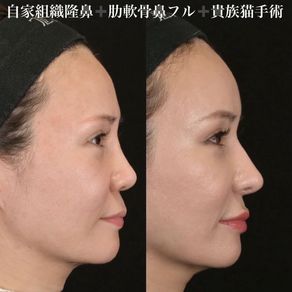 鉄医師による鼻整形の術前/術後３ヶ月 หลัง 